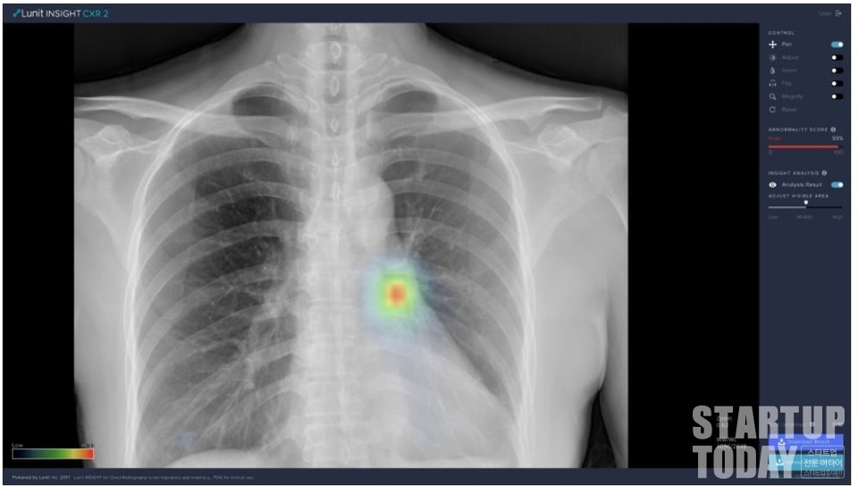 루닛의 폐 질환 진단 보조 인공지능 소프트웨어인 ‘루닛 인사이트 CXR’. 인공지능을 활용해 흉부 엑스레이의 비정상 소견을 표시한다. (사진=루닛)